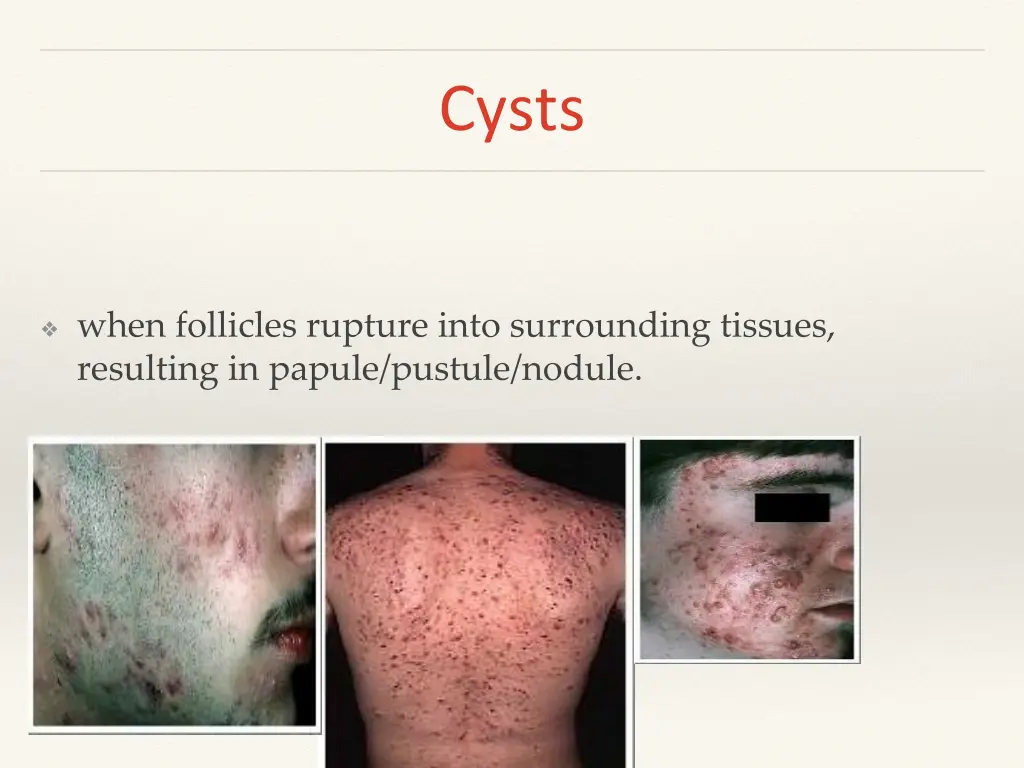 cysts
