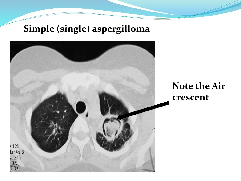 simple single aspergilloma