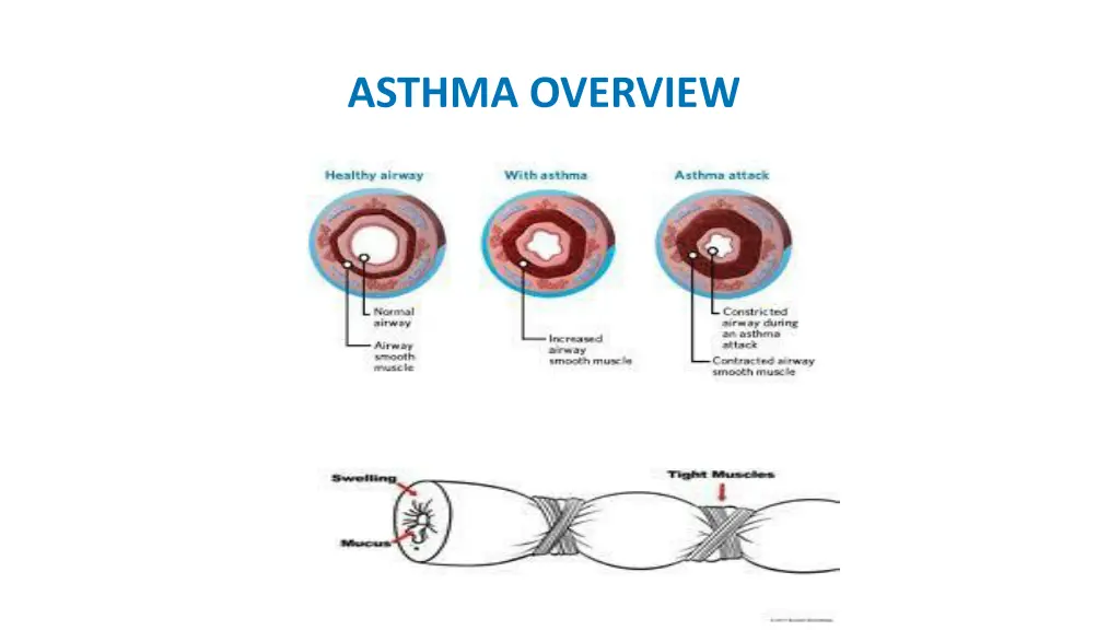 asthma overview 3