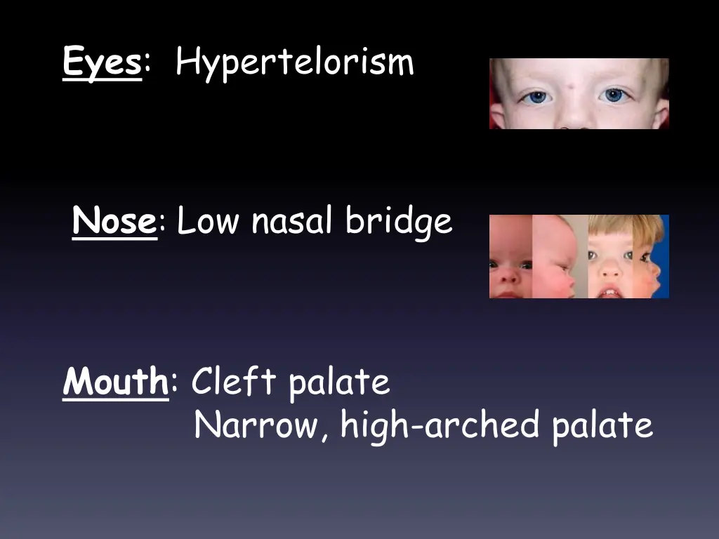 eyes hypertelorism