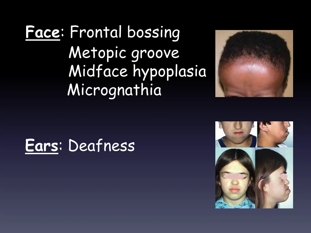 face frontal bossing metopic groove midface