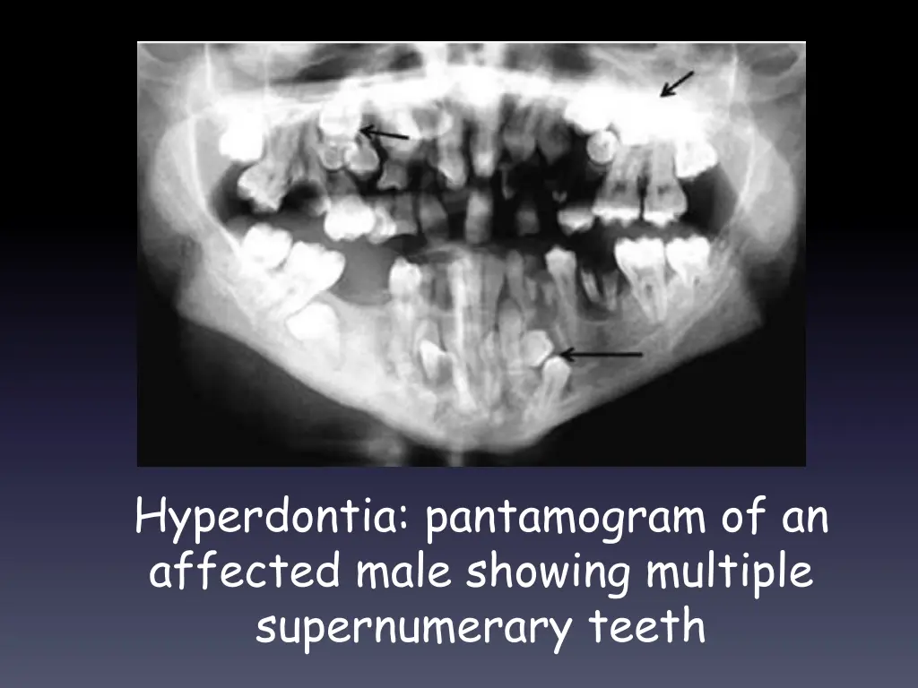 hyperdontia pantamogram of an affected male
