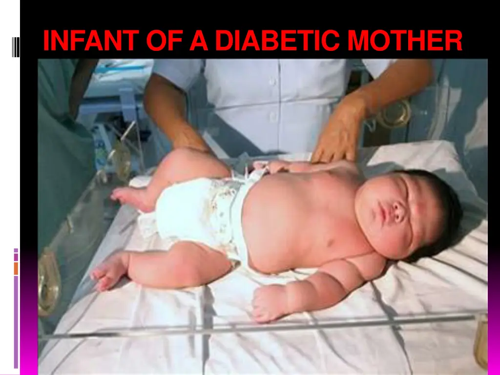 infant of a diabetic mother