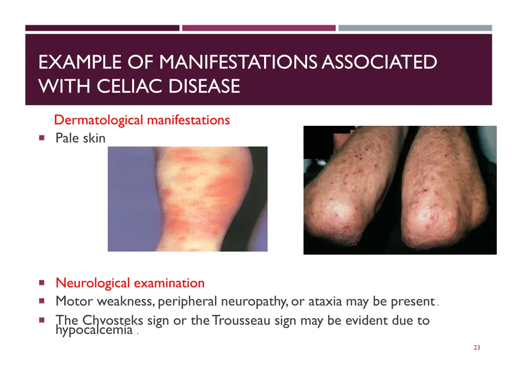 example of manifestations associated with celiac
