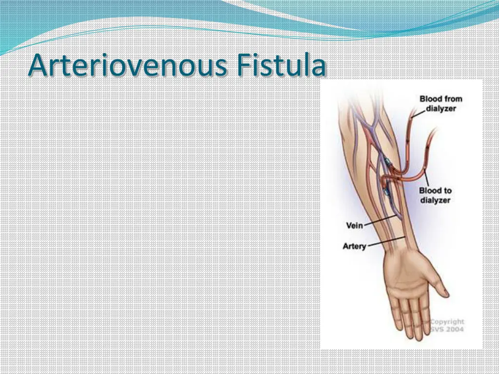 arteriovenous fistula