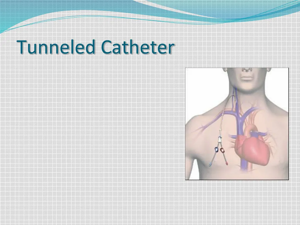 tunneled catheter