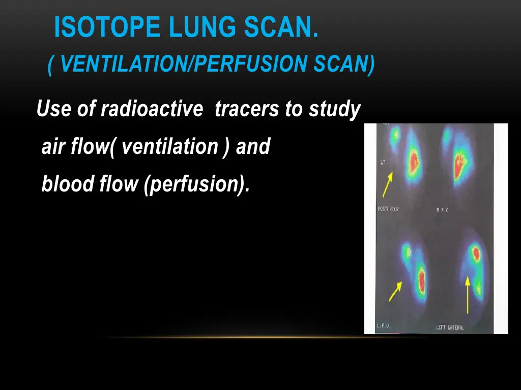 isotope lung scan ventilation perfusion scan