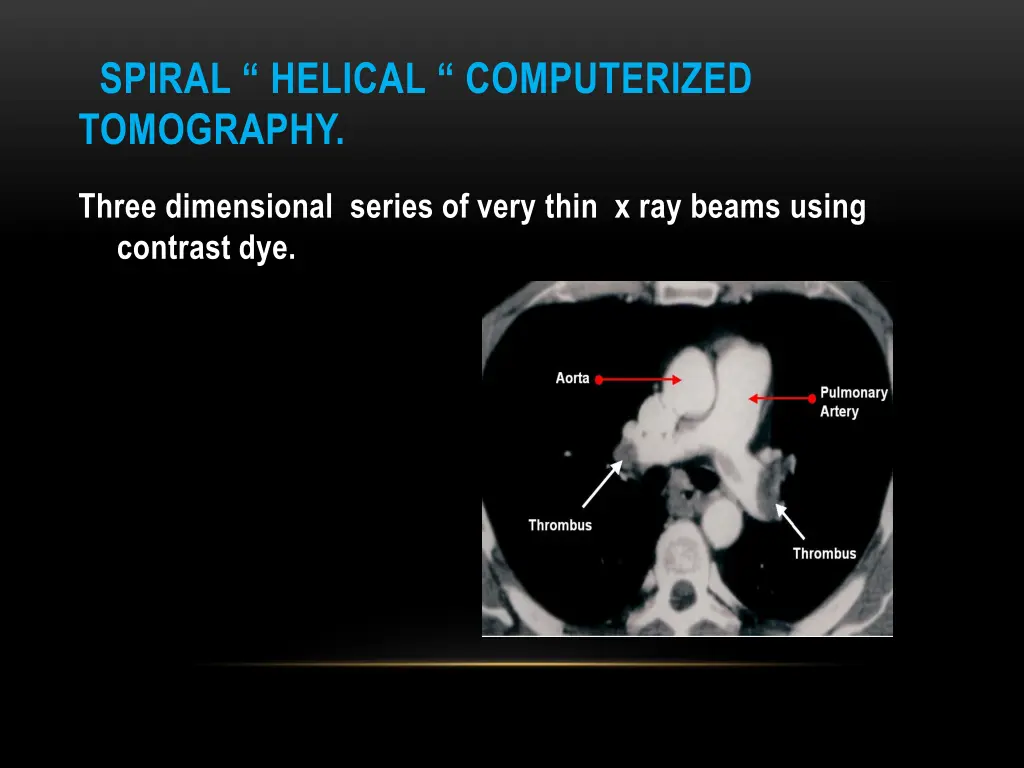 spiral helical computerized tomography