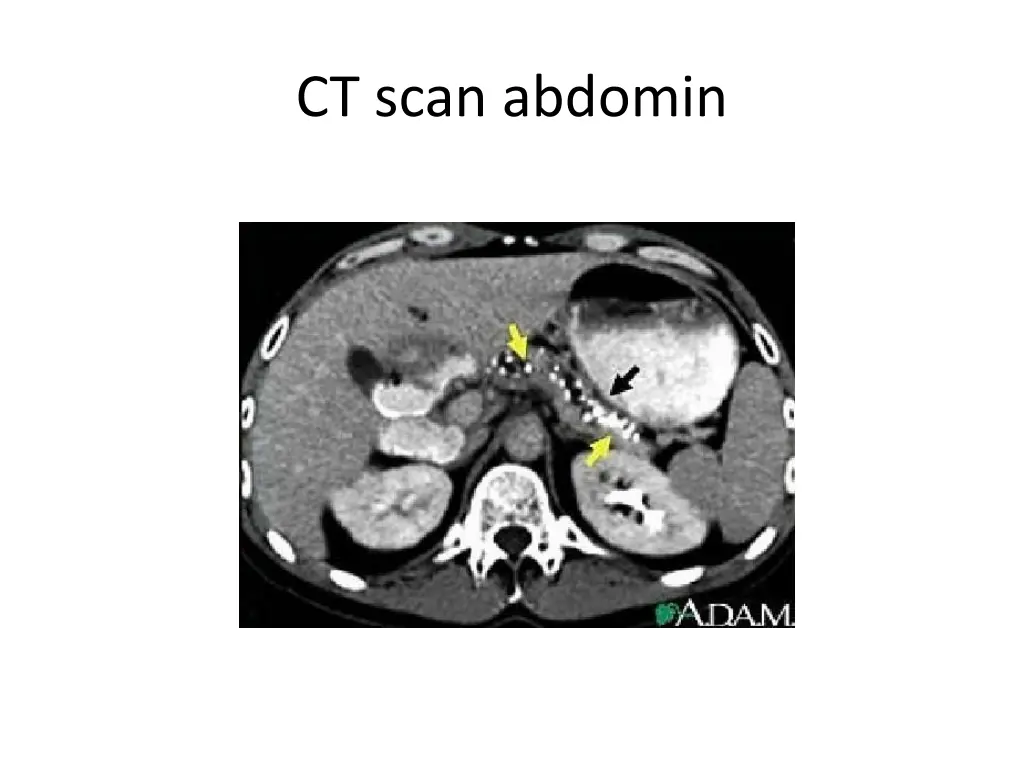 ct scan abdomin