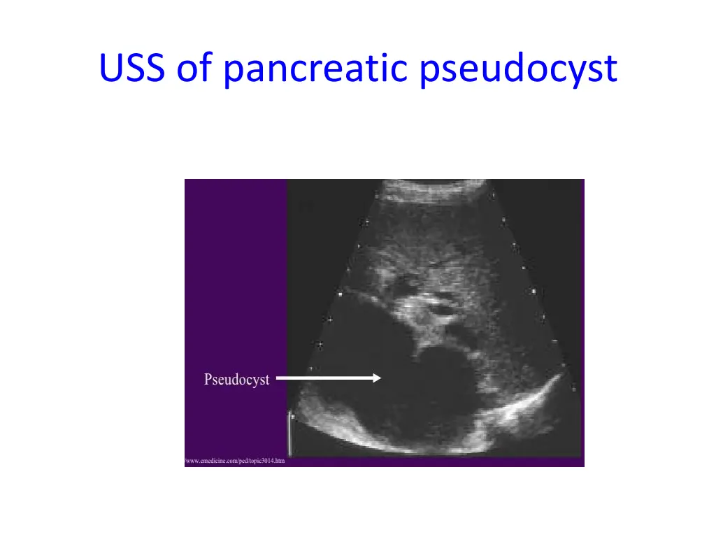 uss of pancreatic pseudocyst
