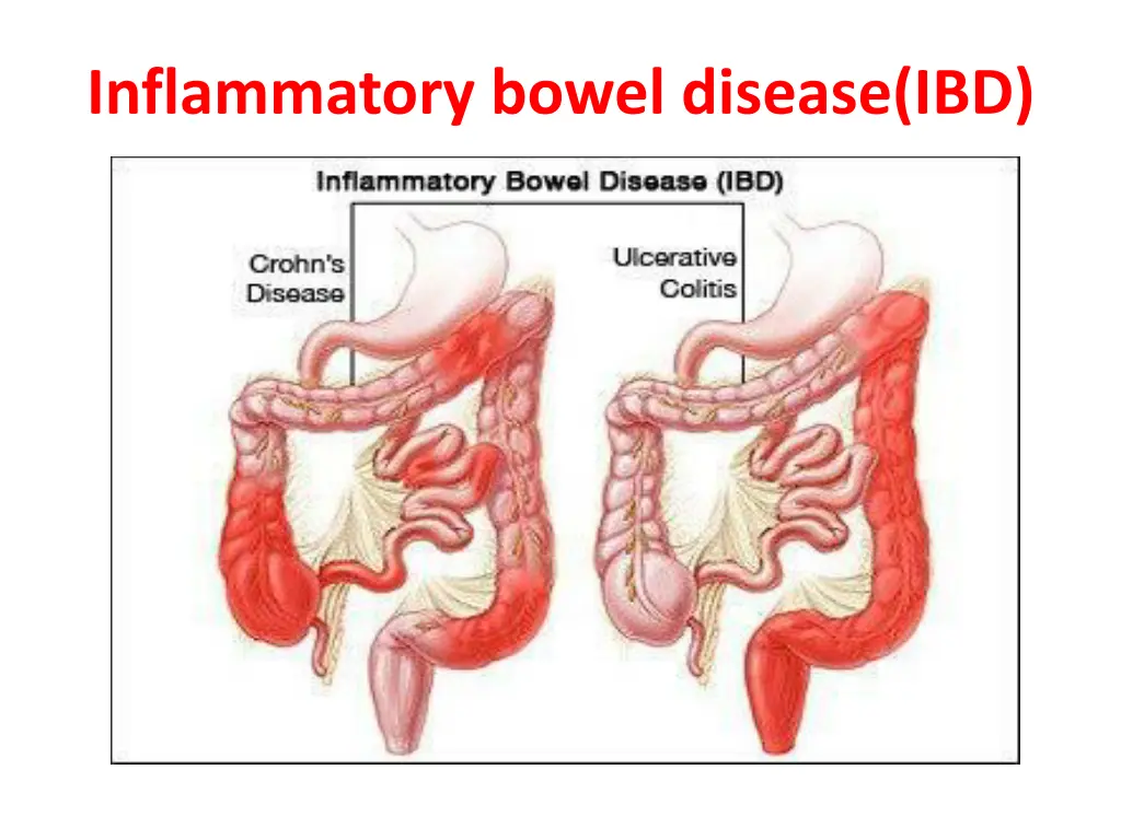 inflammatory bowel disease ibd