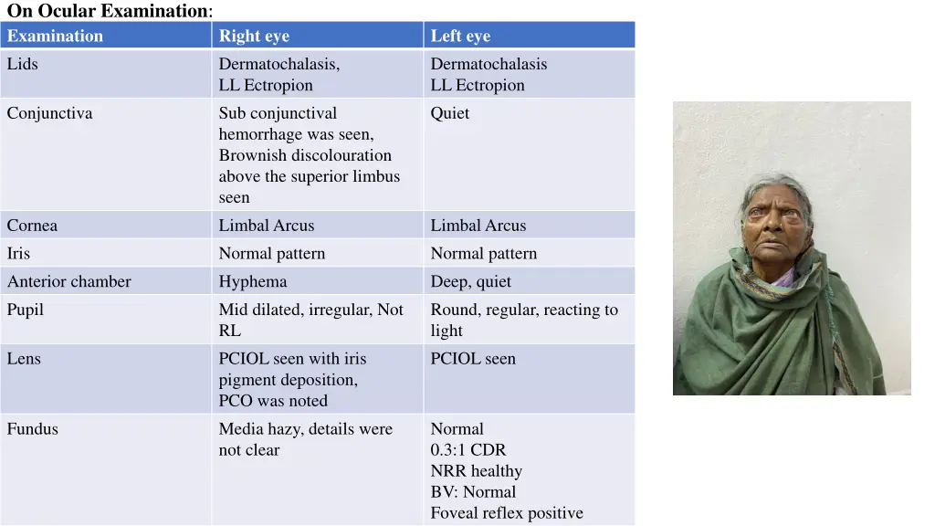 on ocular examination examination lids