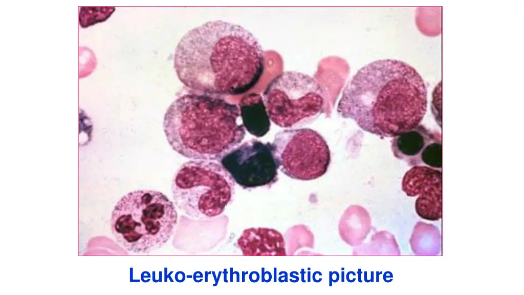 leuko erythroblastic picture