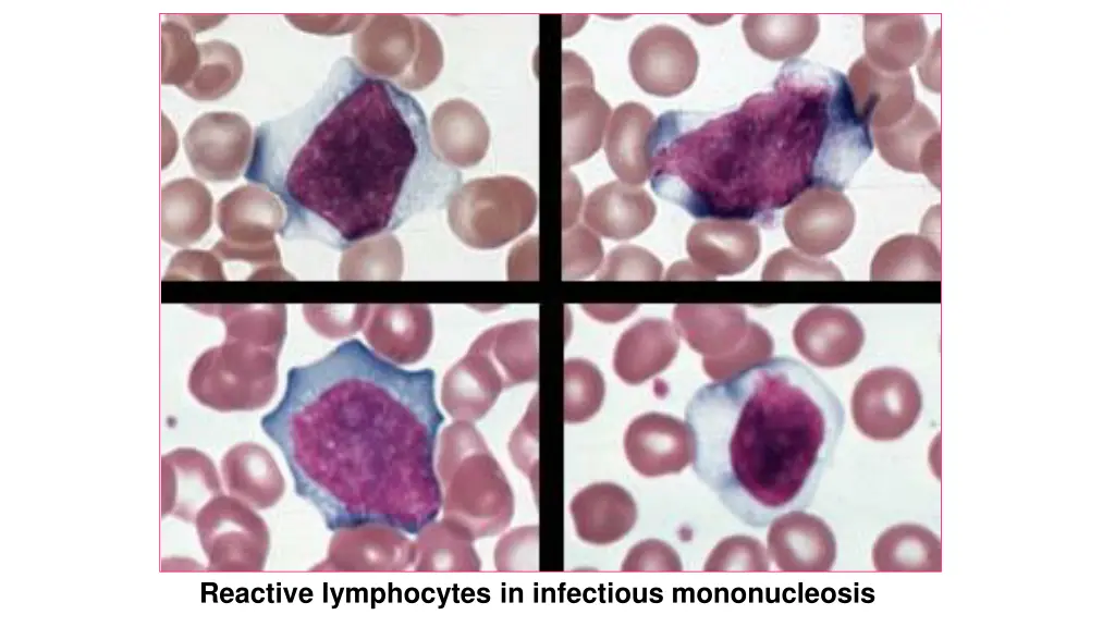 reactive lymphocytes in infectious mononucleosis