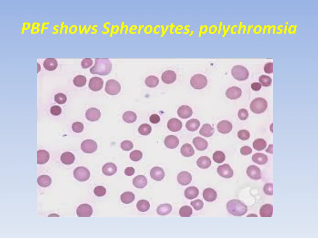 pbf shows spherocytes polychromsia