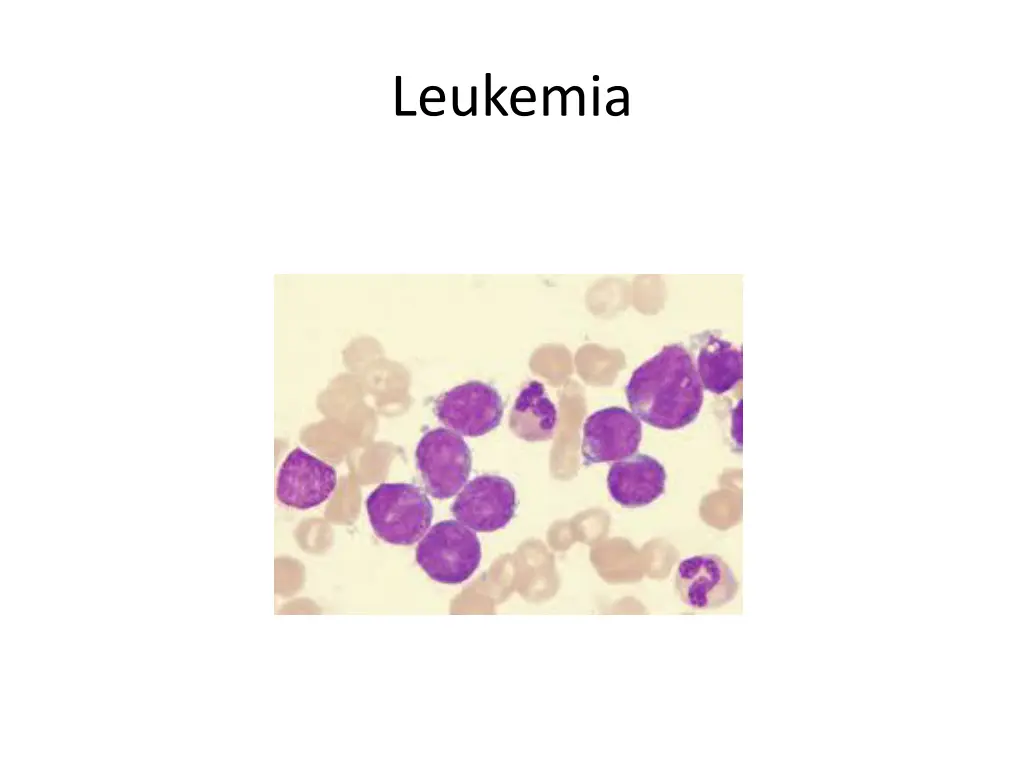 leukemia 1