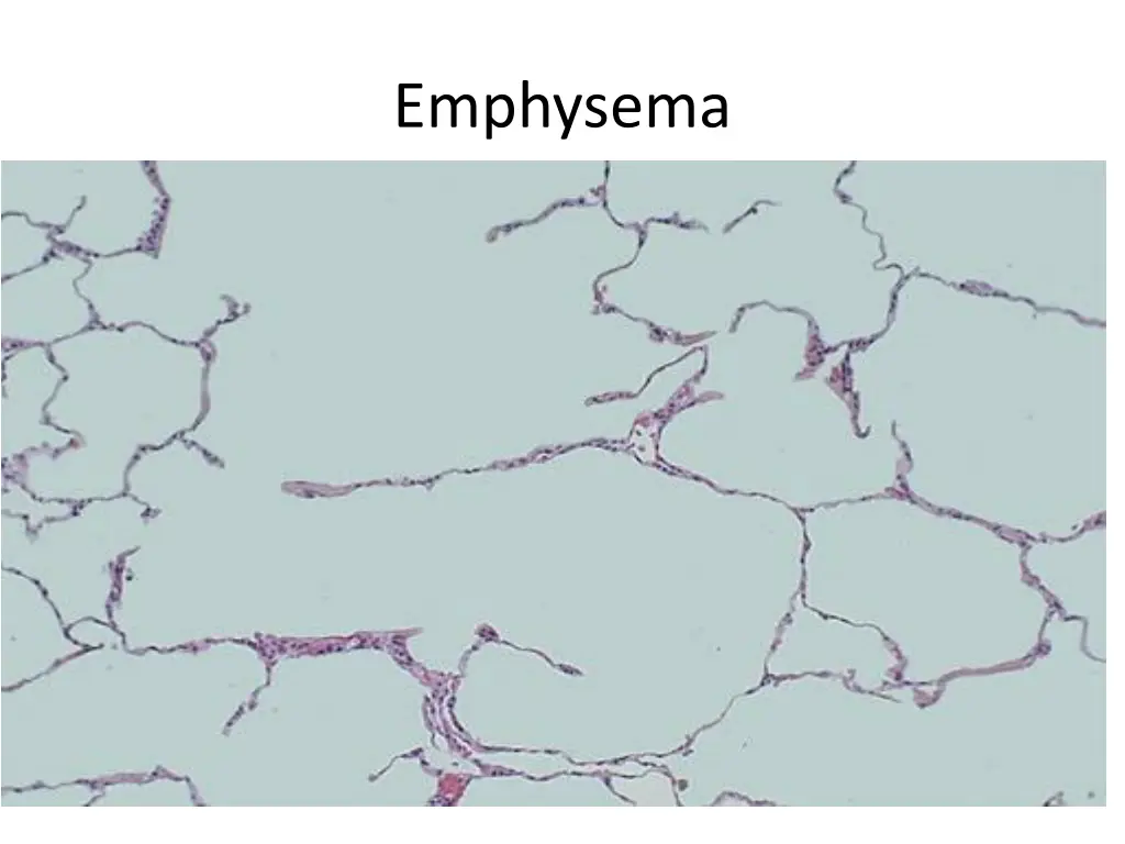 emphysema 1