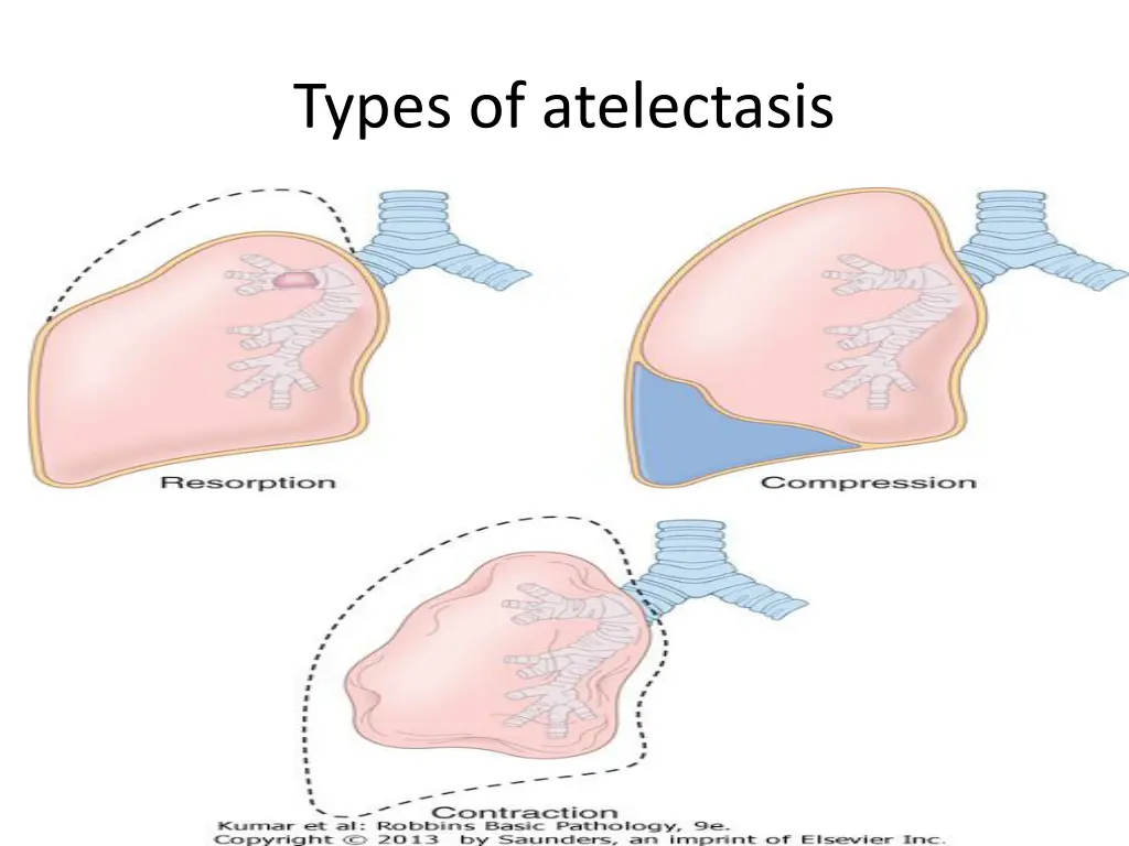 types of atelectasis 1