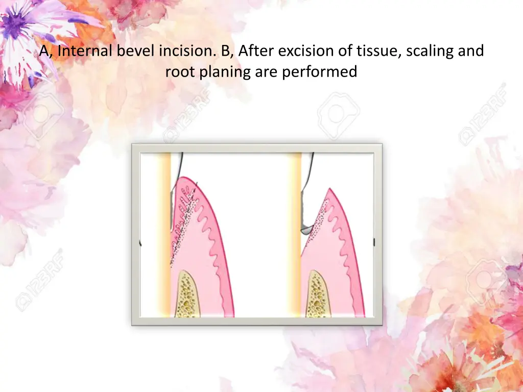 a internal bevel incision b after excision