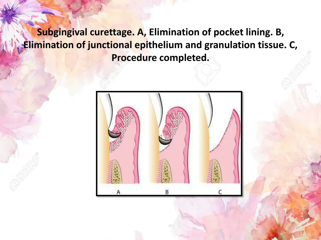 subgingival curettage a elimination of pocket