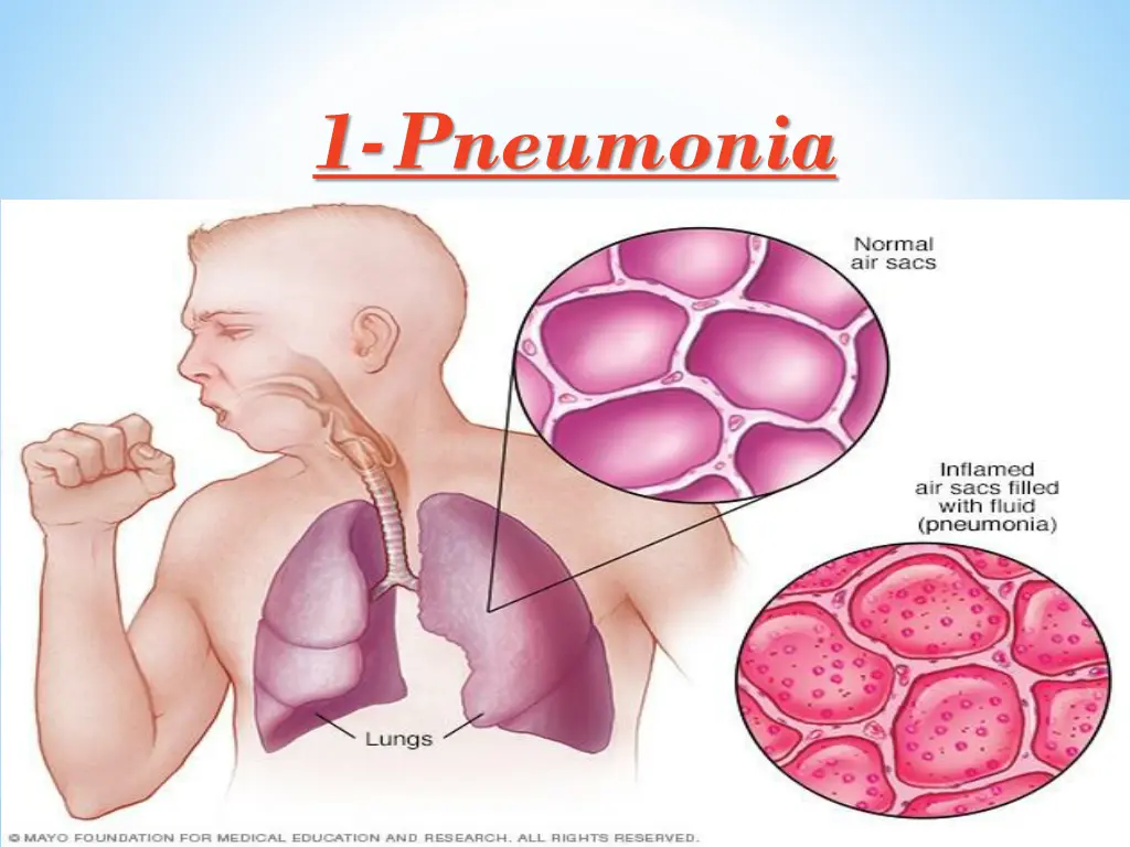 1 pneumonia
