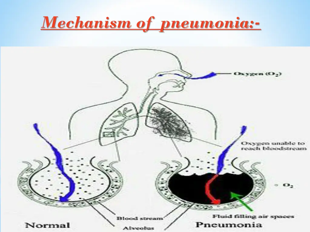 mechanism of pneumonia
