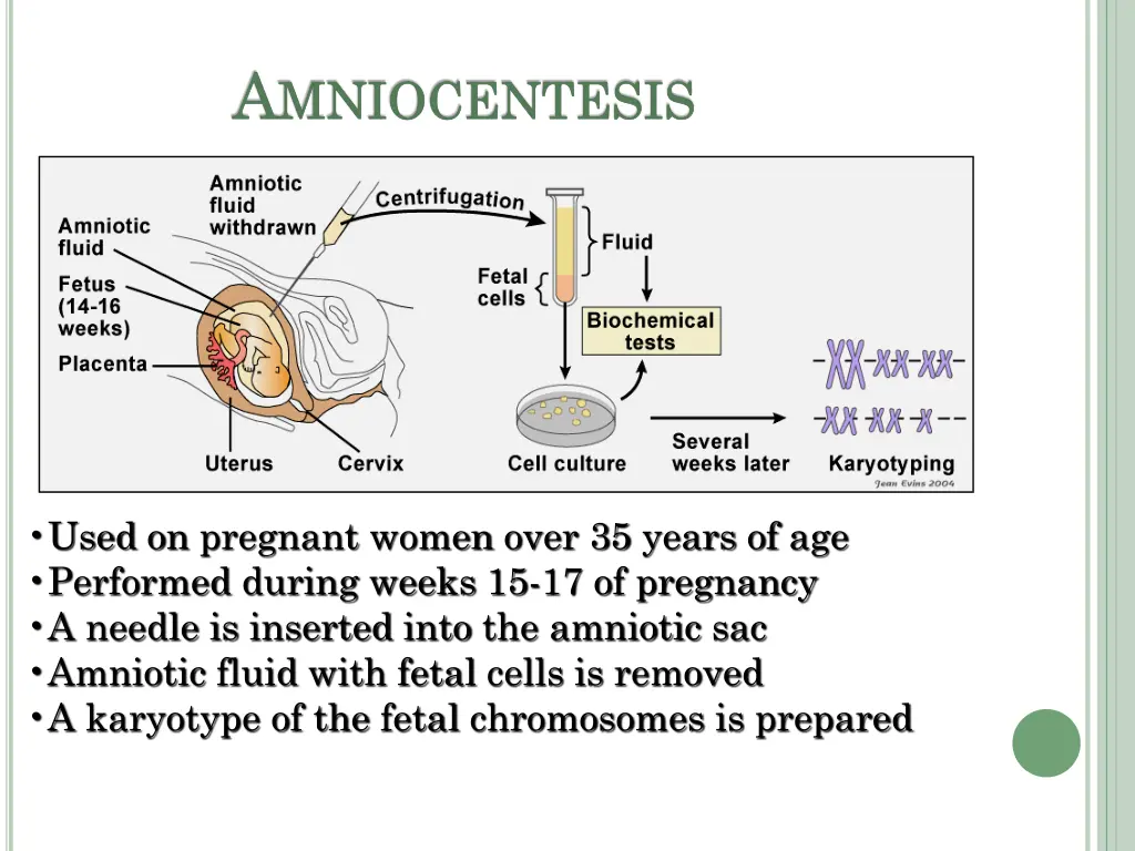 a mniocentesis