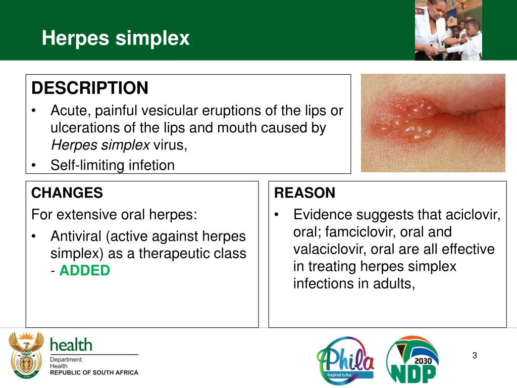 herpes simplex