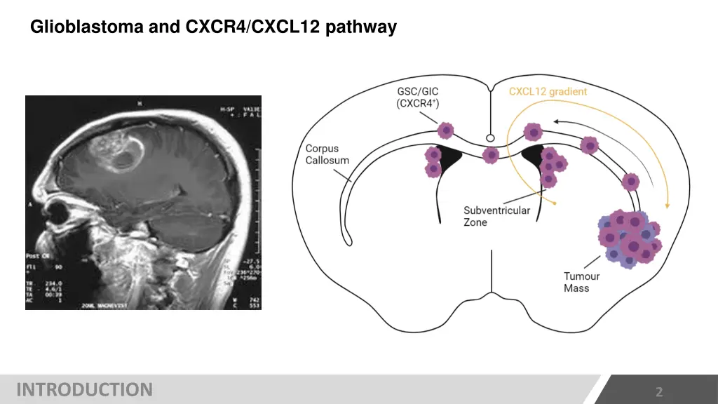 glioblastoma and cxcr4 cxcl12 pathway