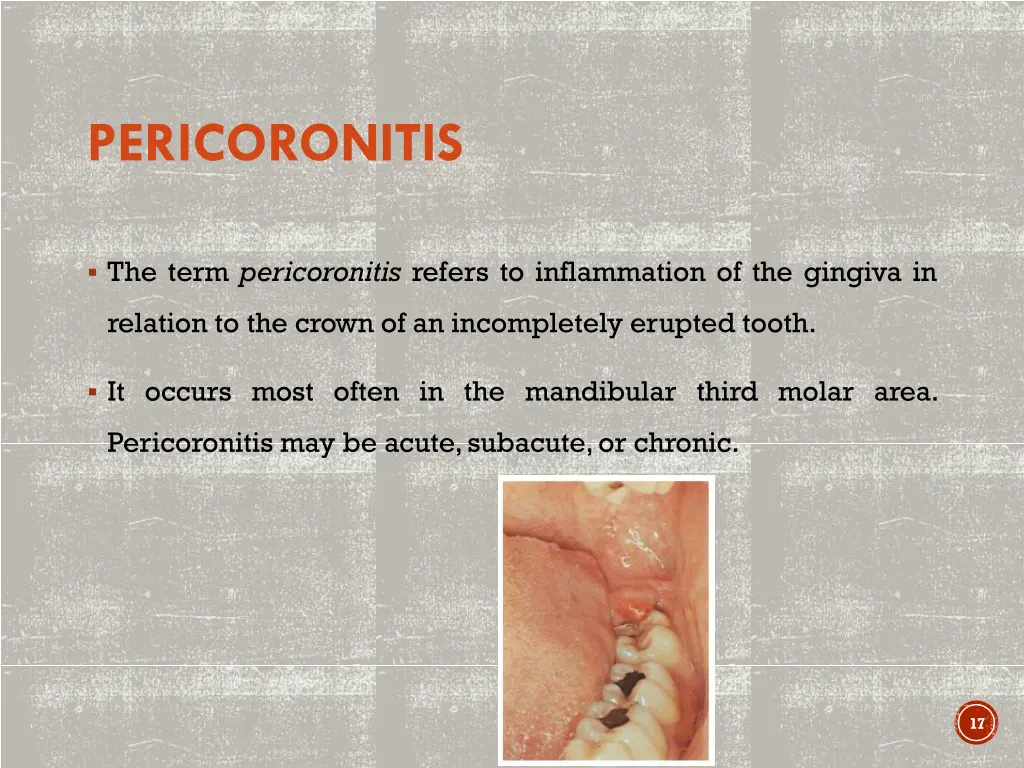 pericoronitis