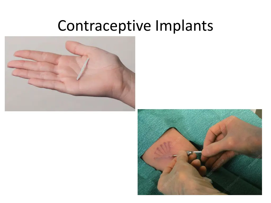 contraceptive implants