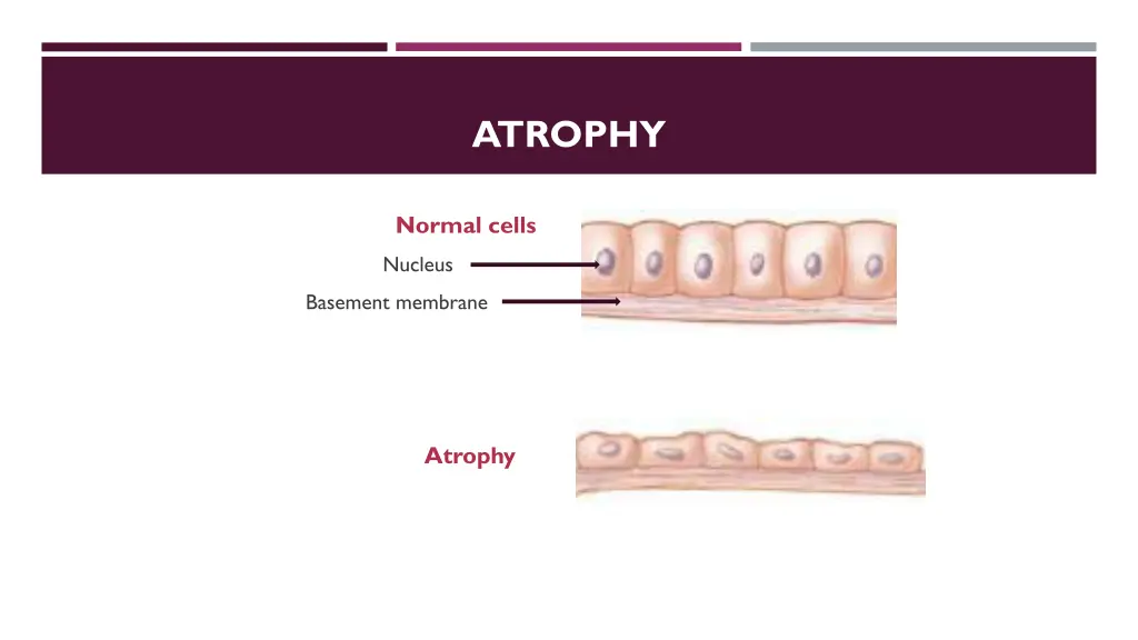 atrophy