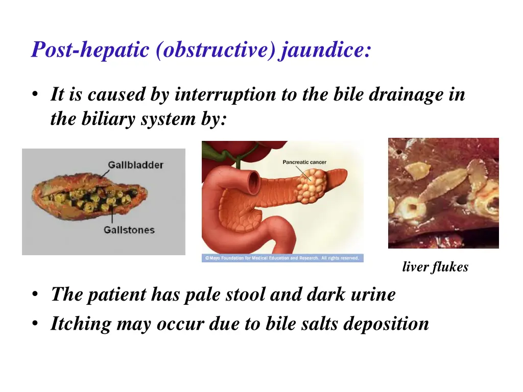 post hepatic obstructive jaundice