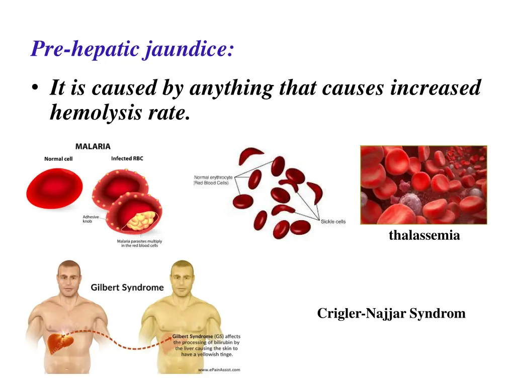 pre hepatic jaundice