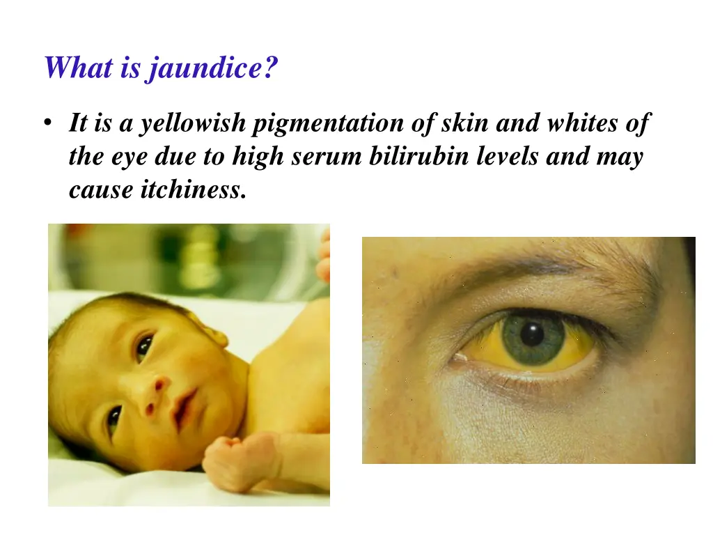 what is jaundice