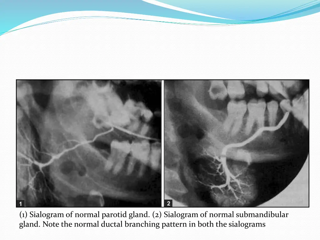 1 sialogram of normal parotid gland 2 sialogram