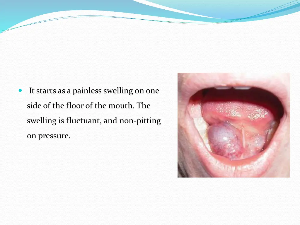 it starts as a painless swelling on one
