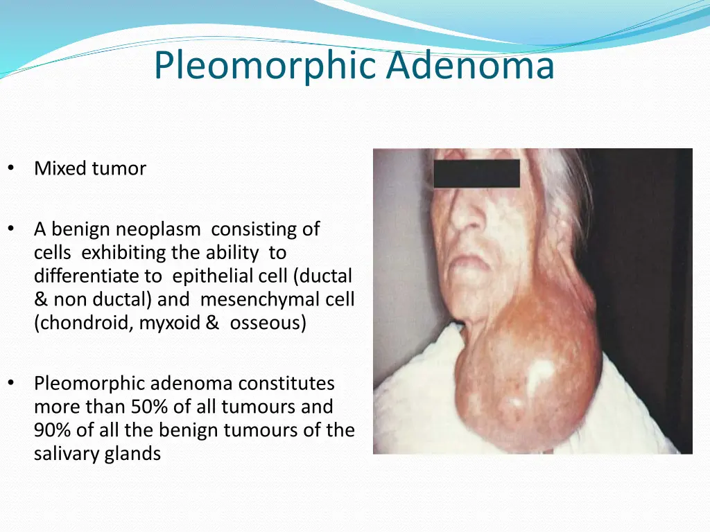 pleomorphic adenoma