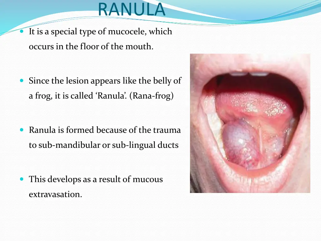 ranula