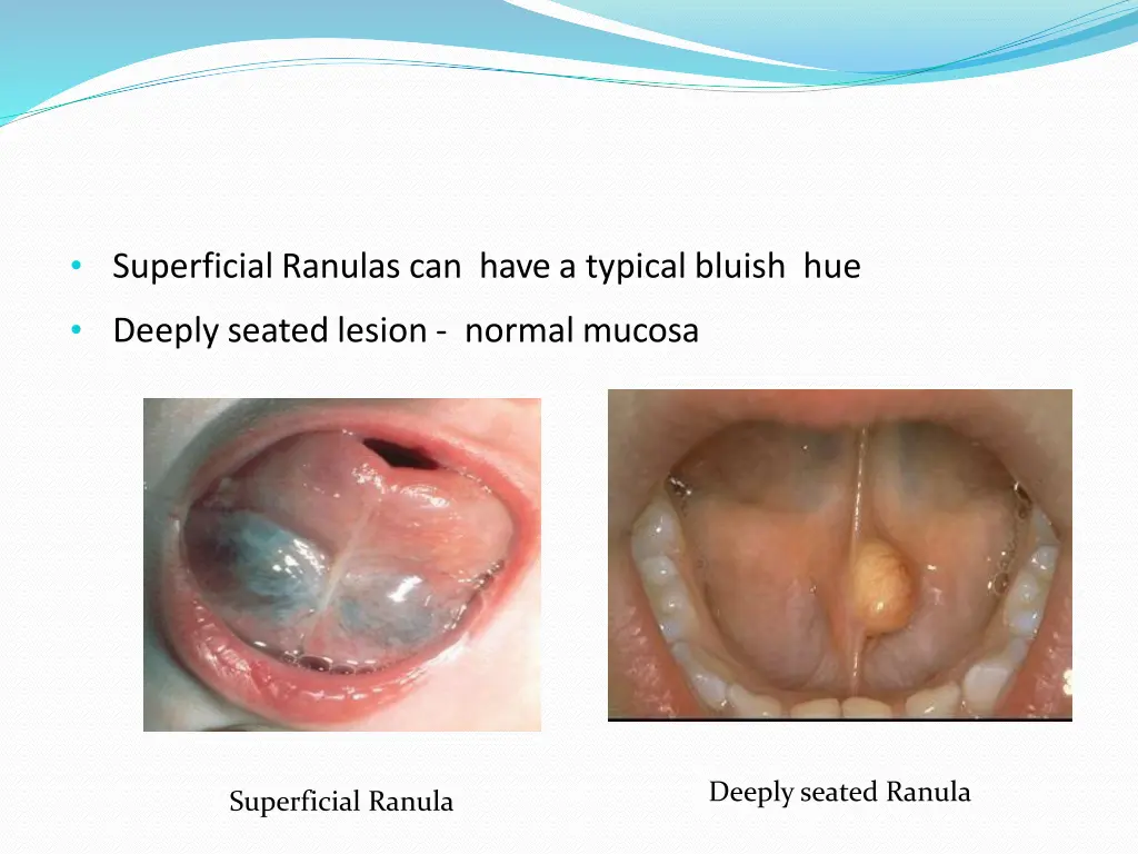 superficial ranulas can have a typical bluish hue