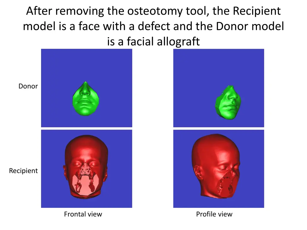 after removing the osteotomy tool the recipient