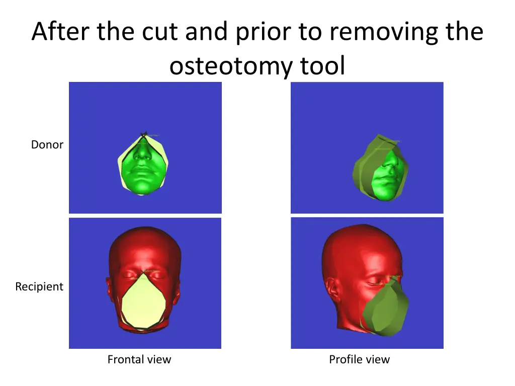 after the cut and prior to removing the osteotomy