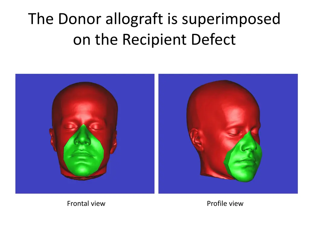 the donor allograft is superimposed