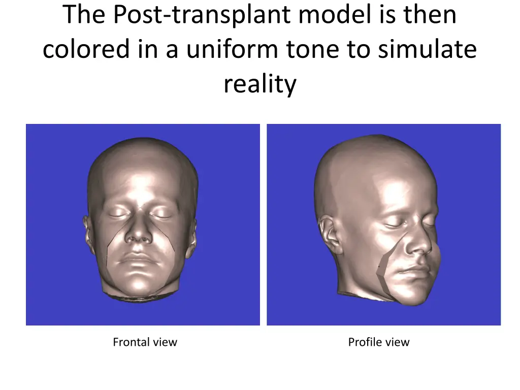 the post transplant model is then colored