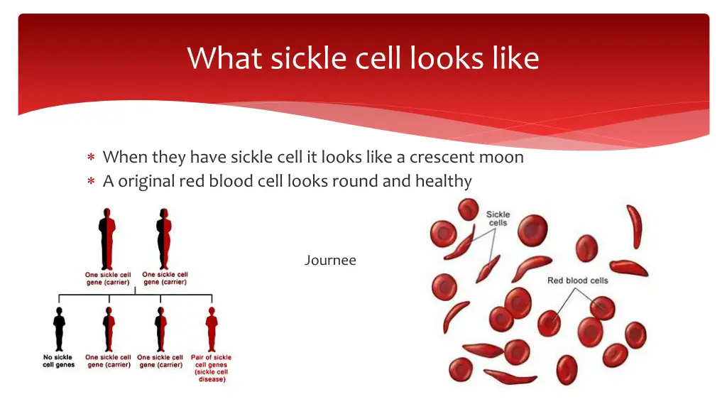 what sickle cell looks like
