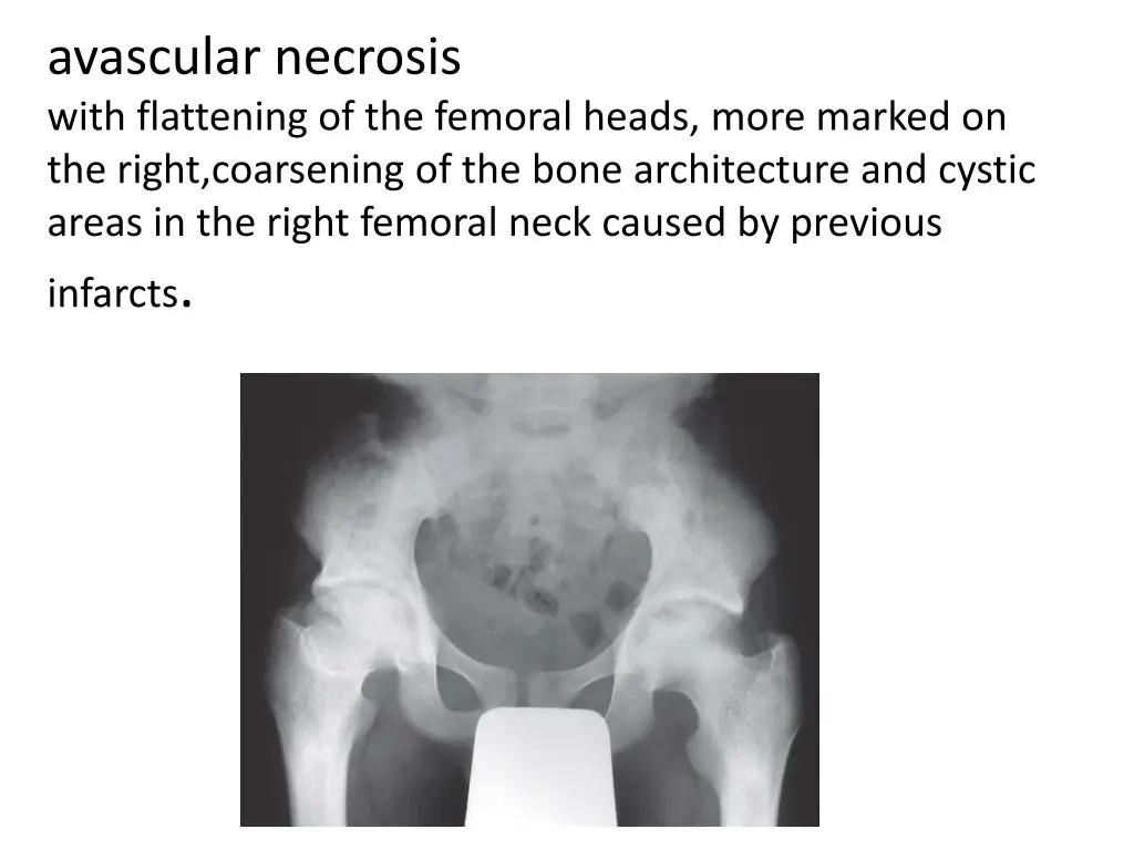 avascular necrosis with flattening of the femoral
