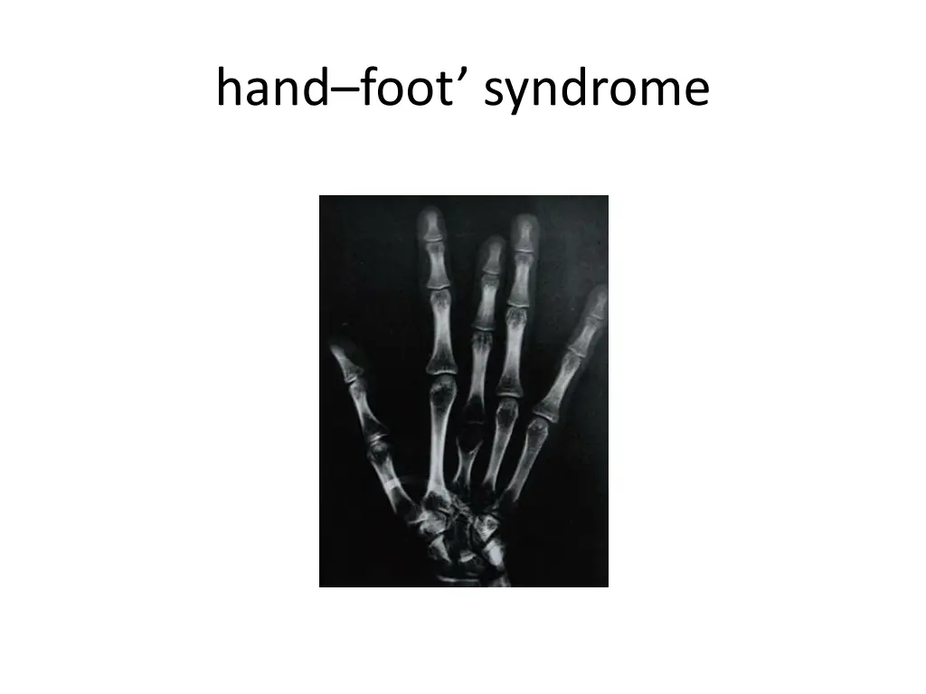 hand foot syndrome