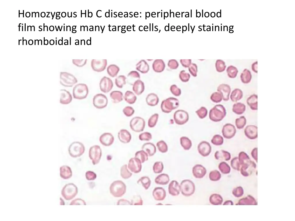 homozygous hb c disease peripheral blood film