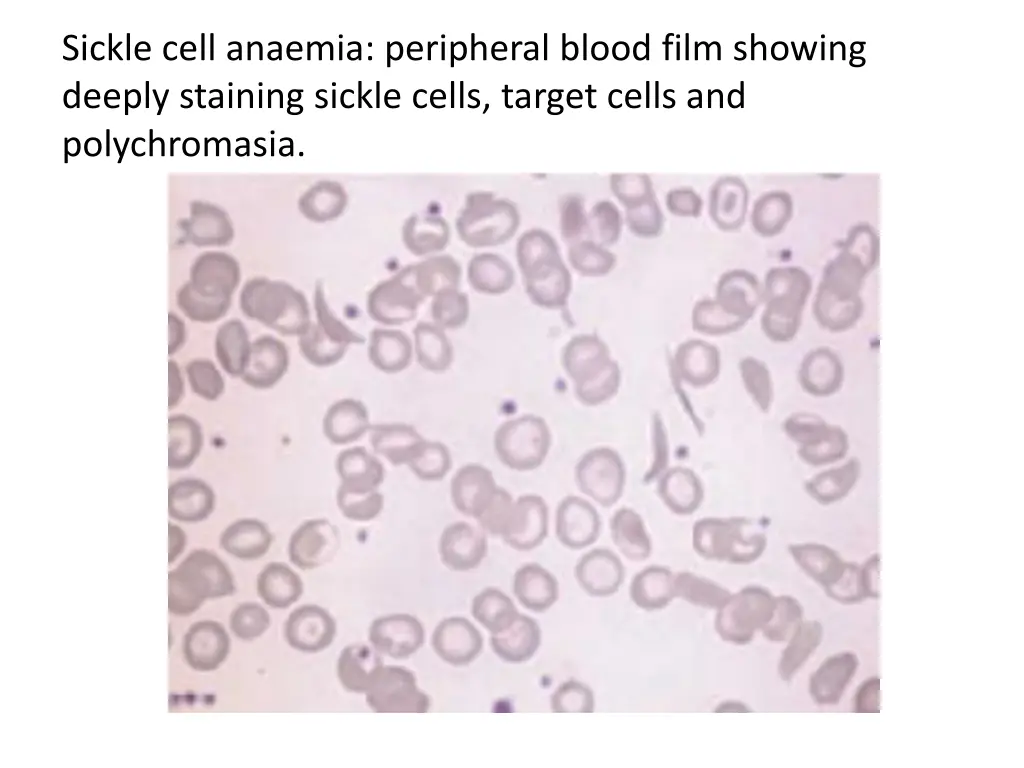 sickle cell anaemia peripheral blood film showing