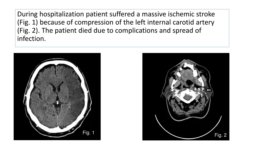 during hospitalization patient suffered a massive